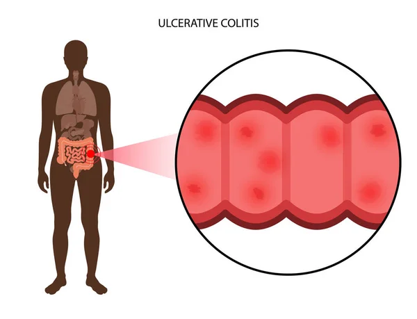 Colite ulcerosa intestinale — Vettoriale Stock
