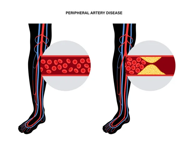 Periphere Arterienkrankheit — Stockvektor