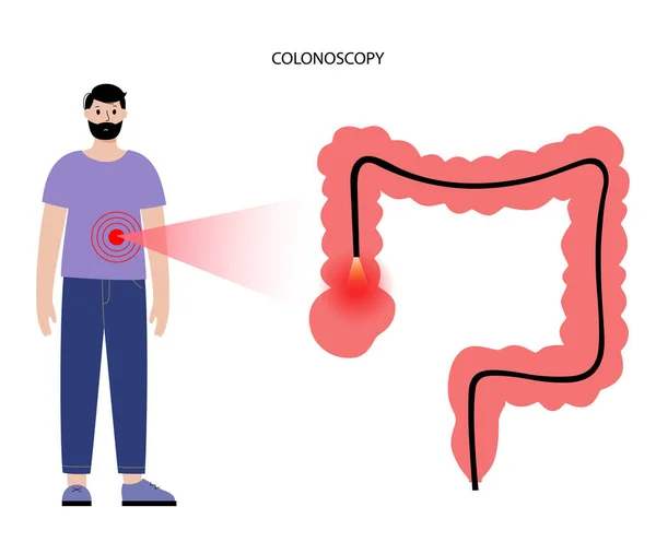 Concepto de procedimiento de colonoscopia — Archivo Imágenes Vectoriales