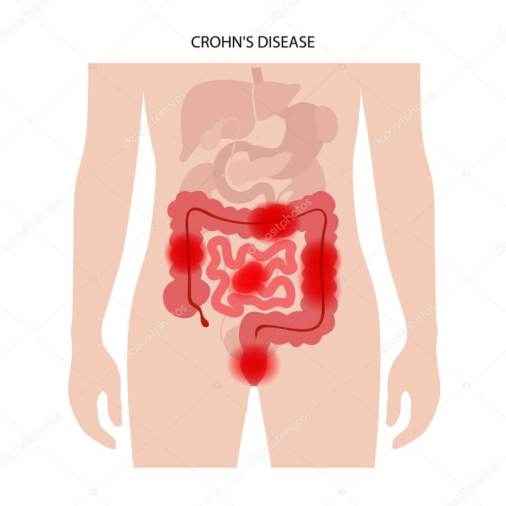 Chrons disease concept