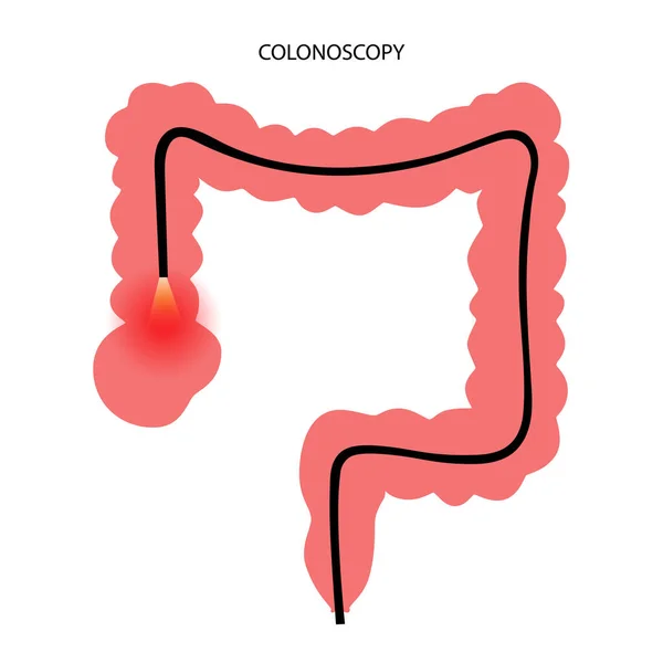 Koncepce postupu kolonoskopie — Stockový vektor