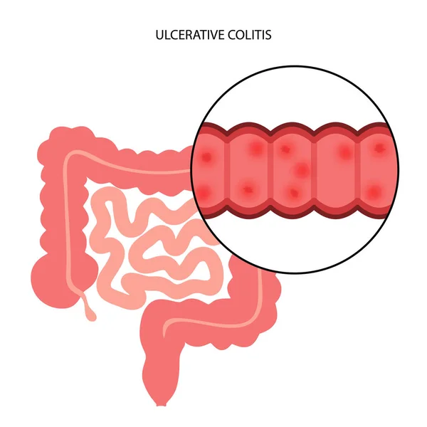 Bélfekély colitis — Stock Vector