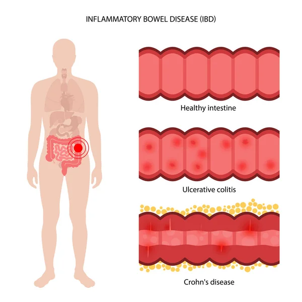 炎症性肠道疾病 — 图库矢量图片