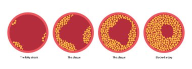 Cholesterol and atherosclerosis clipart