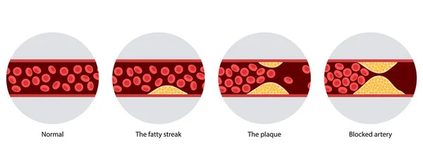 Cholesterol i miażdżyca — Wektor stockowy