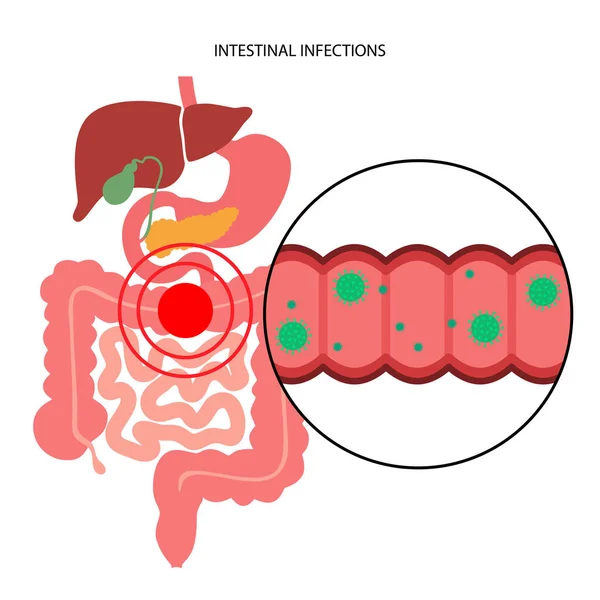 肠内感染疾病 — 图库矢量图片