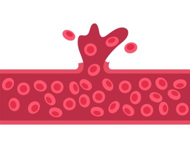 Beyin kanaması geçiriyor.