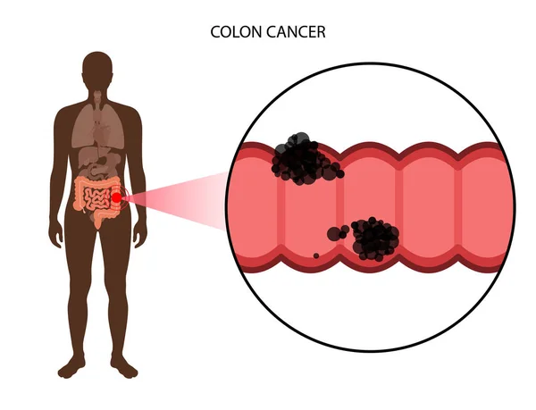 Fase di cancro al colon — Vettoriale Stock