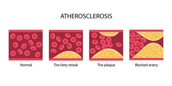 胆固醇和动脉粥样硬化 — 图库矢量图片