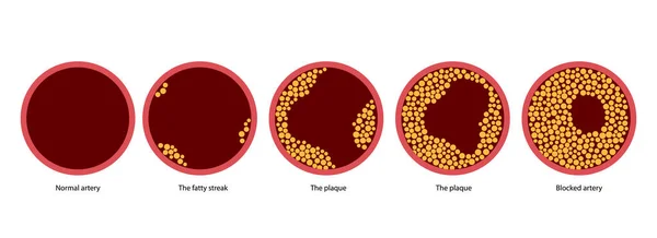 Cholesterol a ateroskleróza — Stockový vektor