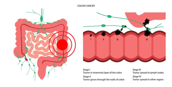 Estadio del cáncer de colon — Vector de stock