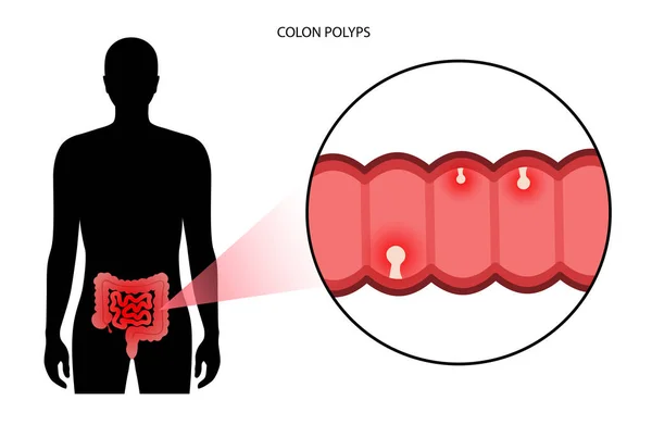 Polipi del colon infiammazione — Vettoriale Stock