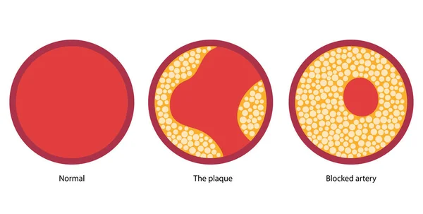 コレステロールとアテローム性動脈硬化症 — ストックベクタ