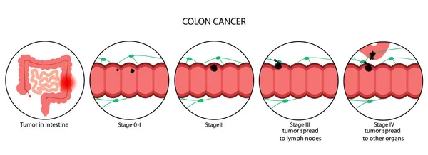 Kolon kanseri aşaması — Stok Vektör