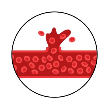 Beyin kanaması geçiriyor.