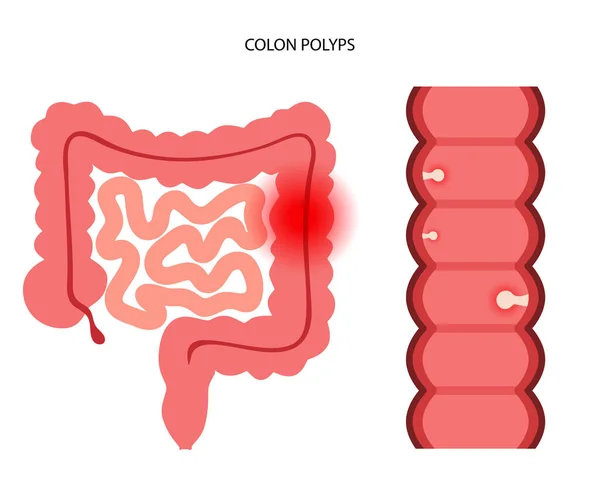 Colón pólipos inflamación — Archivo Imágenes Vectoriales