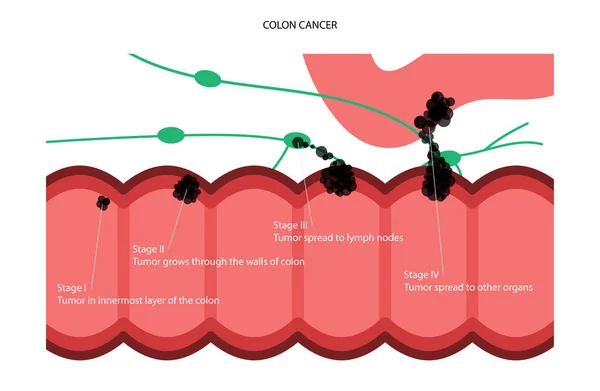 Fase di cancro al colon — Vettoriale Stock