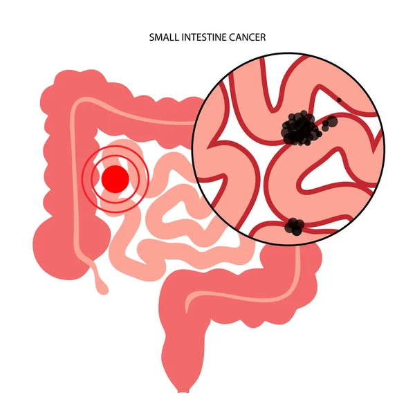 小肠癌 — 图库矢量图片