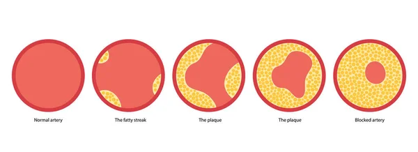 Cholesterin und Arteriosklerose — Stockvektor