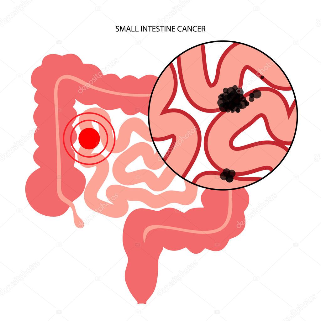 Small intestine cancer