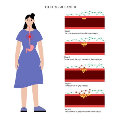 esophageal cancer stages clipart