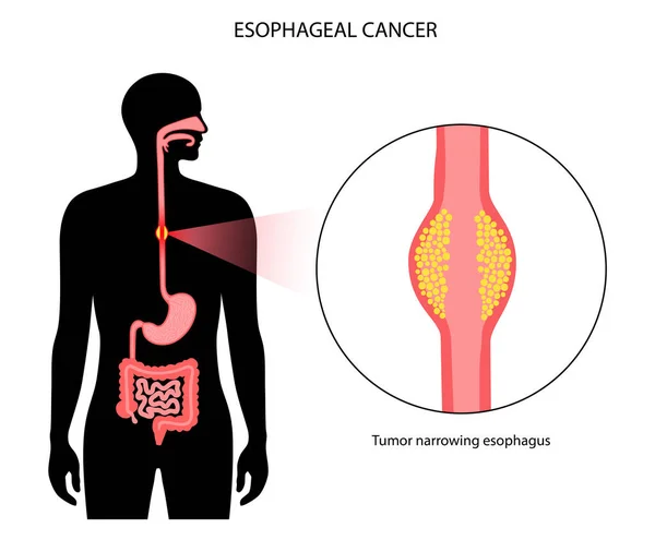 Concepto de cáncer de esófago — Vector de stock
