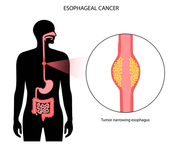 Speiseröhrenkrebs-Konzept — Stockvektor