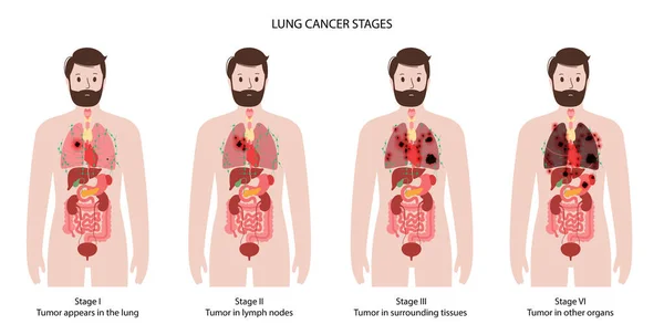 肺がん期 — ストックベクタ