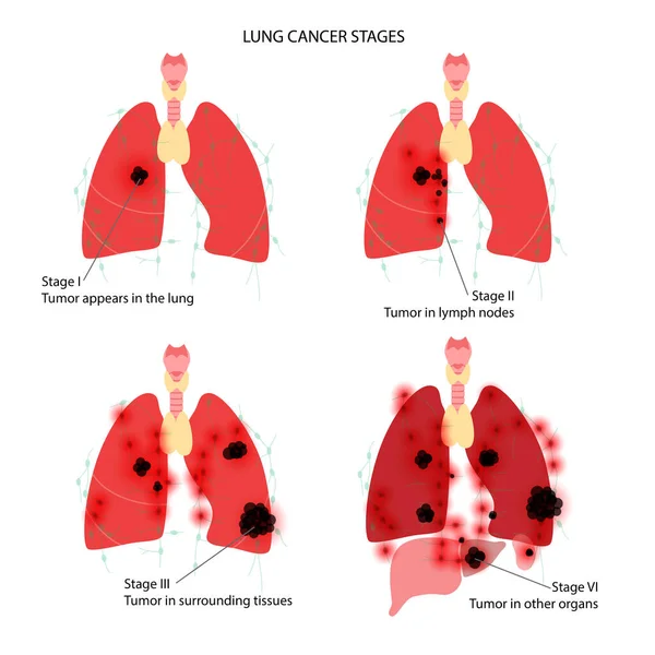 肺がん疾患 — ストックベクタ