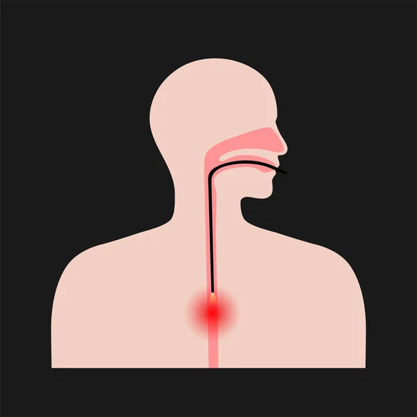 Procedura endoscopica dell'esofago — Vettoriale Stock