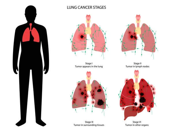 Estadios del cáncer pulmonar — Vector de stock