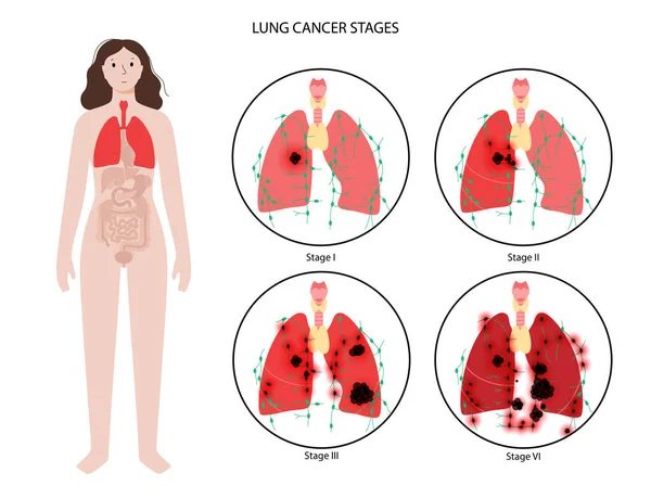 Etapy raka płuc — Wektor stockowy