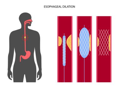 Esophageal dilation procedure clipart