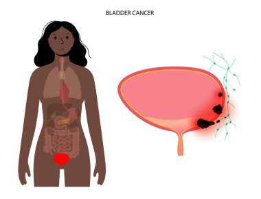 Mesane kanseri aşamaları