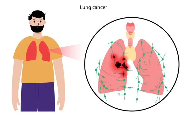 Enfermedad por cáncer de pulmón — Vector de stock