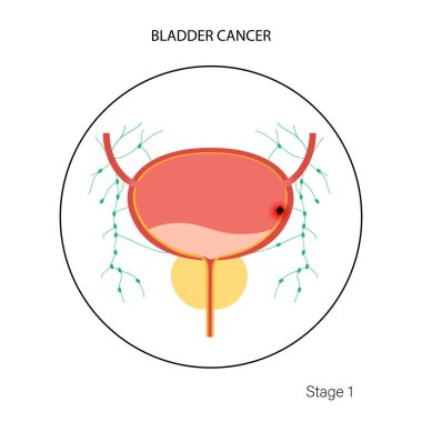 Mesane kanseri aşamaları