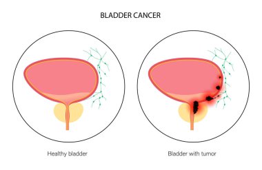 Mesane kanseri aşamaları