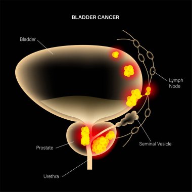 Mesane kanseri aşamaları