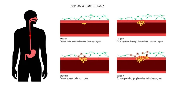 Estadios del cáncer de esófago — Vector de stock