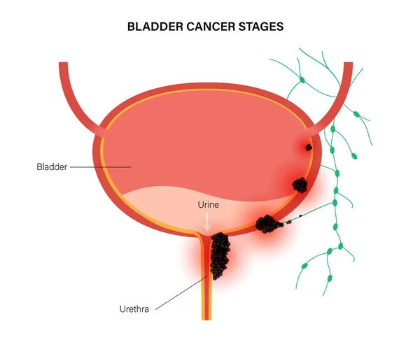 Estadios del cáncer de vejiga — Archivo Imágenes Vectoriales