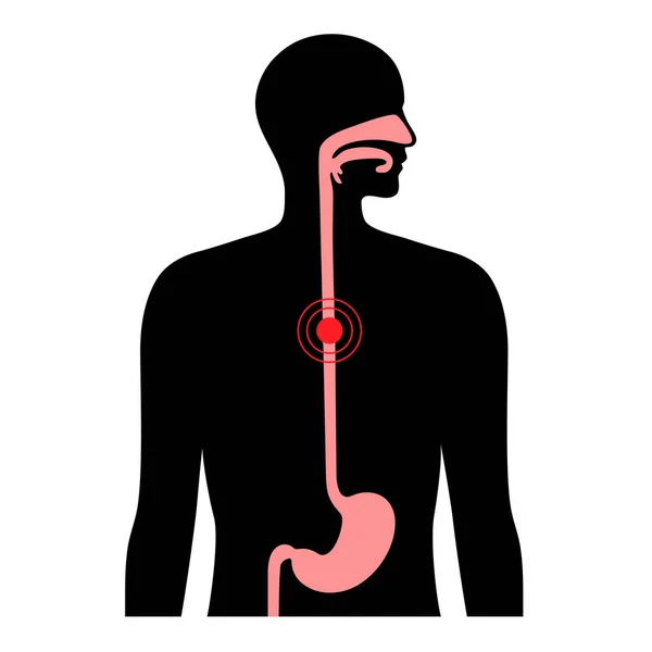 Esophageal cancer concept — Stock Vector