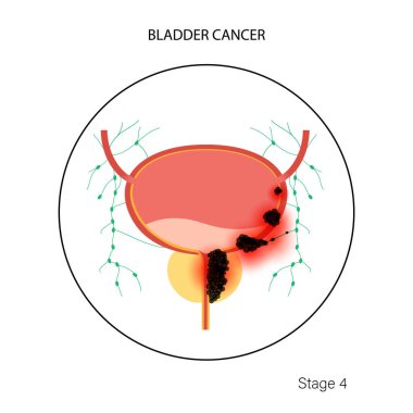 Mesane kanseri aşamaları