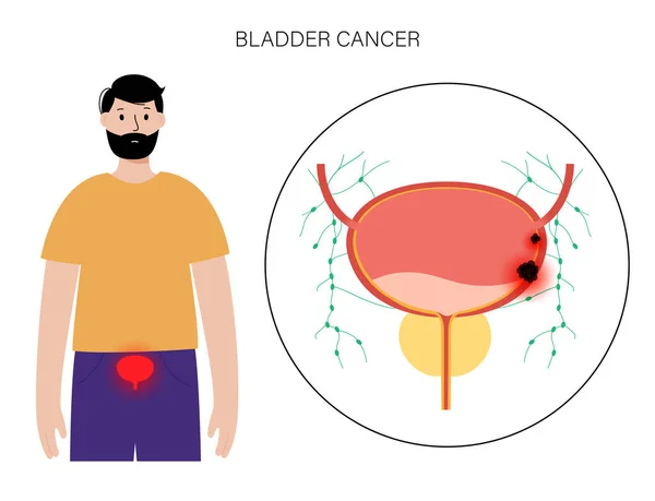 Bladder cancer stages — Stock Vector