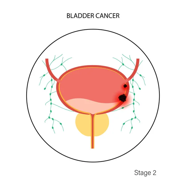 Fase van blaaskanker — Stockvector