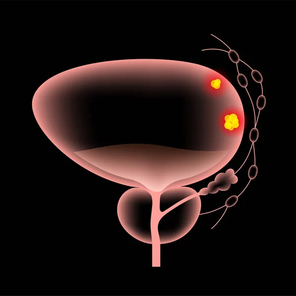 Stadi di cancro alla vescica — Vettoriale Stock