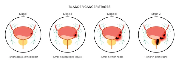 膀胱癌分期 — 图库矢量图片