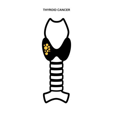 Tiroid kanseri aşamaları