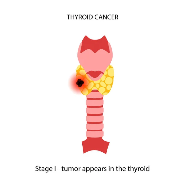 Estadios del cáncer de tiroides — Vector de stock