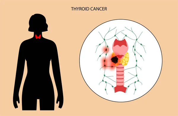 Estadios del cáncer de tiroides — Vector de stock