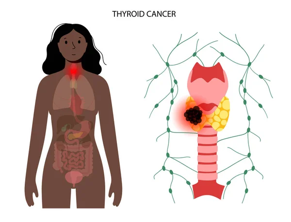 Στάδια καρκίνου του θυρεοειδούς — Διανυσματικό Αρχείο